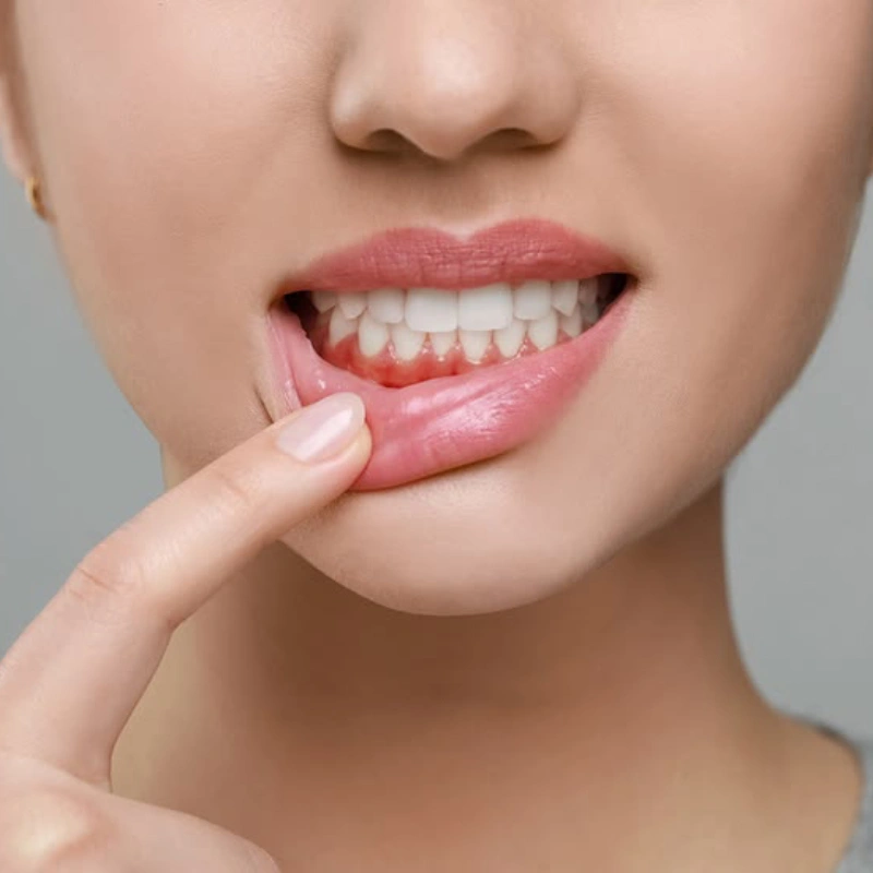 DentalPlaque